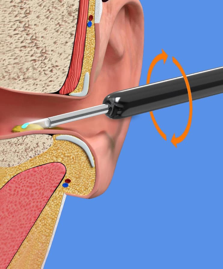 Smart Ear Cleaner with 1296P HD Camera, Wireless Earwax Removal with WiFi Endoscope, Safe Inspection and Intelligent Temperature Control, White
