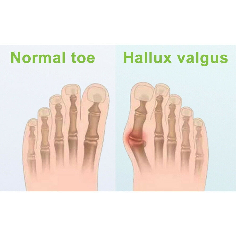 Onemayship Silicone Gel Toe Separator Orthotics Bunion Toes Spacer Pain Reliever 12Pcs